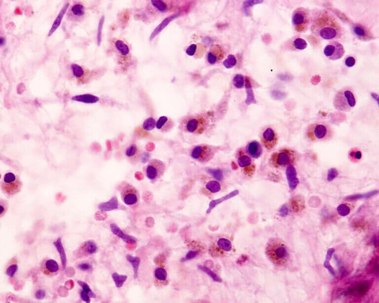 Enfermedad de Letterer-Siwe: proliferación anormal de histiocitos