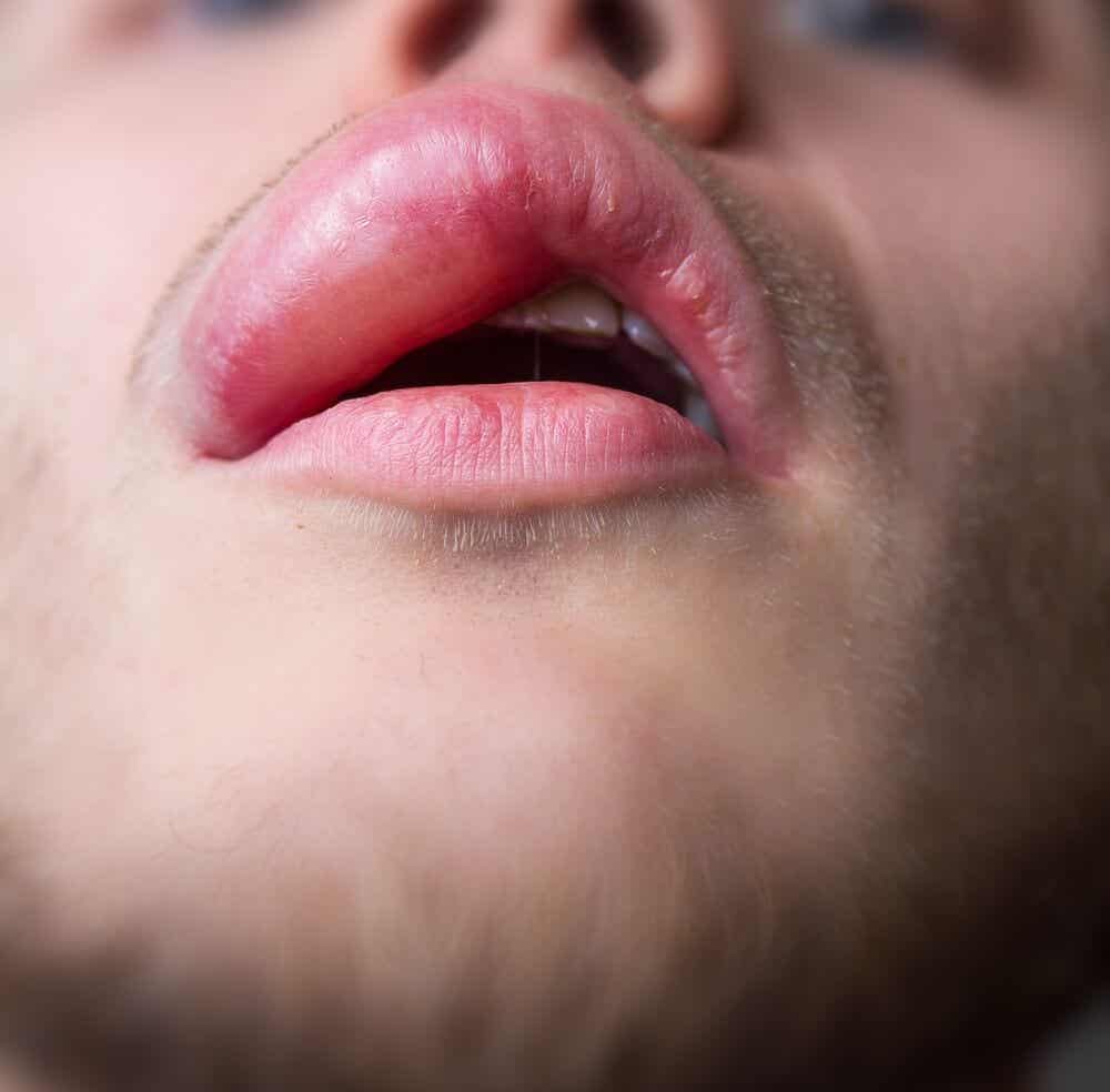 7 remedios caseros para los labios hinchados