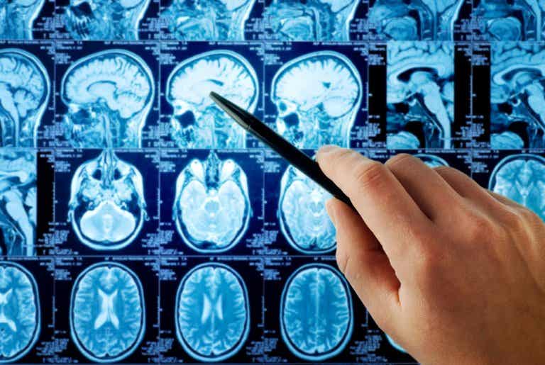 ¿Cuáles son los primeros síntomas del cáncer de cerebro?