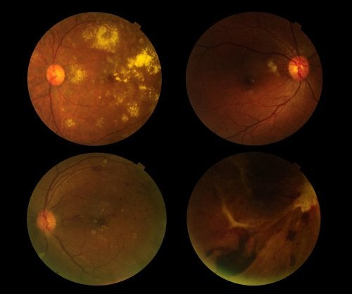 Prevención de la degeneración macular