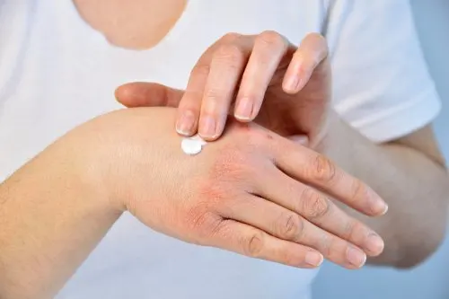 Hidratarse para evitar manchas y pecas en las manos