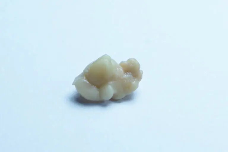 Tonsilolitos, cómo evitarlos y cuál es su tratamiento