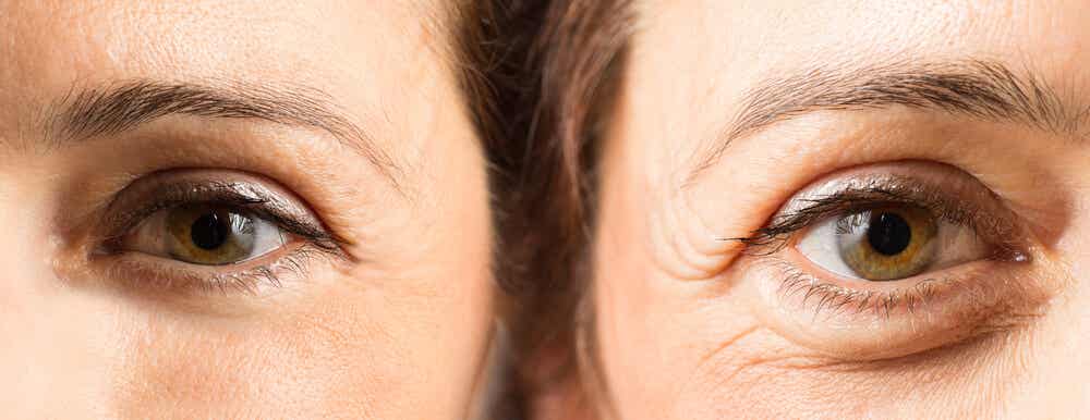 Blefaroplastia: la cirugía para quitar las bolsas en los ojos