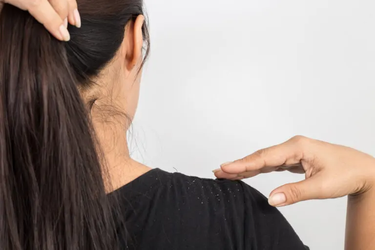 ¿Tienes caspa en tu cabello? Dile adiós con un tratamiento de huevo