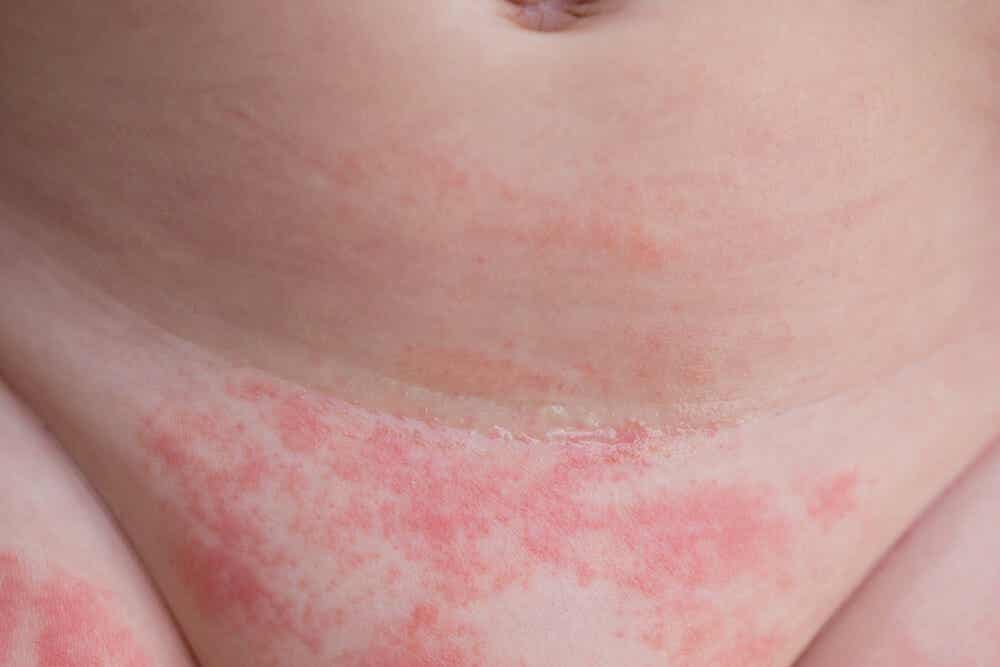 4 consejos para evitar la dermatitis del pañal