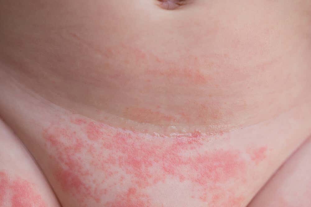 Dermatitis del pañal.
