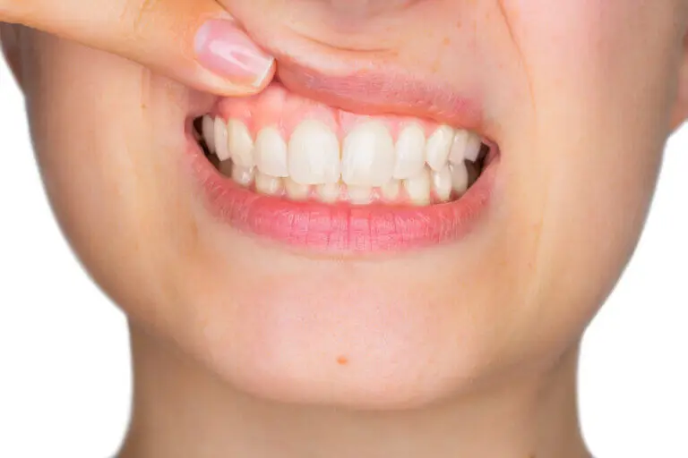 ¿Tus encías sangran habitualmente? Estos remedios lo solucionan