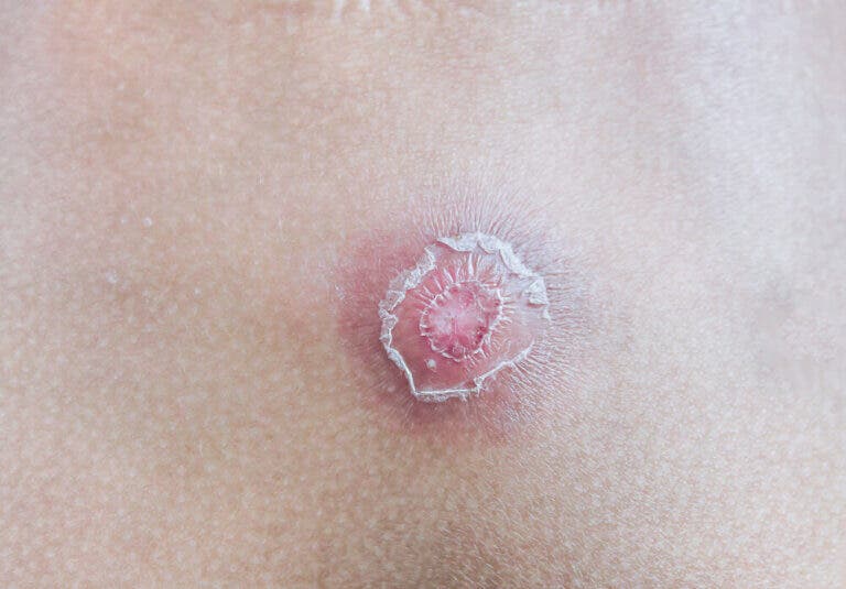 ¿Qué son los forúnculos? 7 consejos para combatirlos