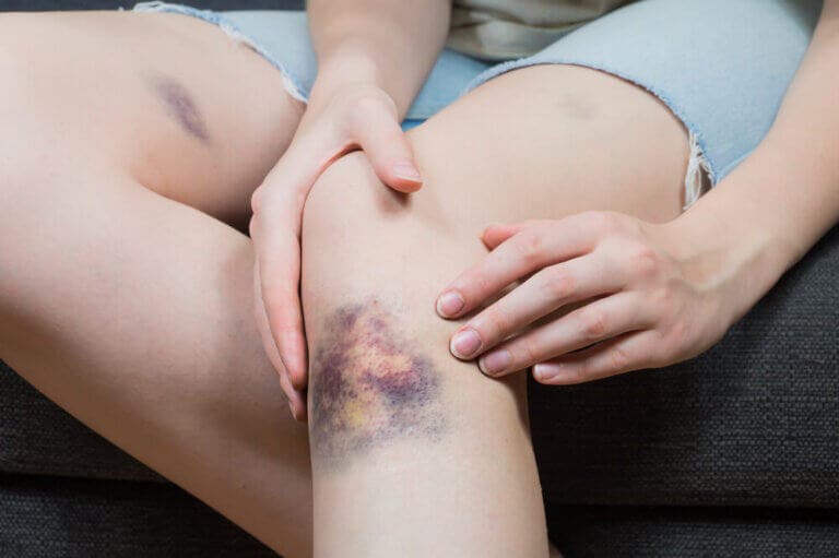 5 soluciones naturales para atenuar los hematomas