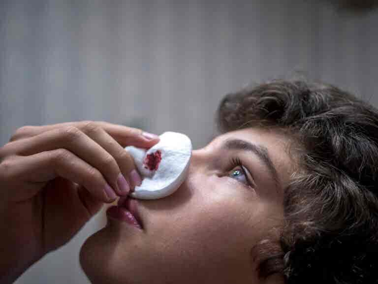 ¿Sabes detener una hemorragia nasal? 7 remedios que te ayudan