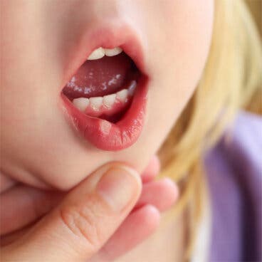 Herpes en niños: ¿cómo tratarlo?