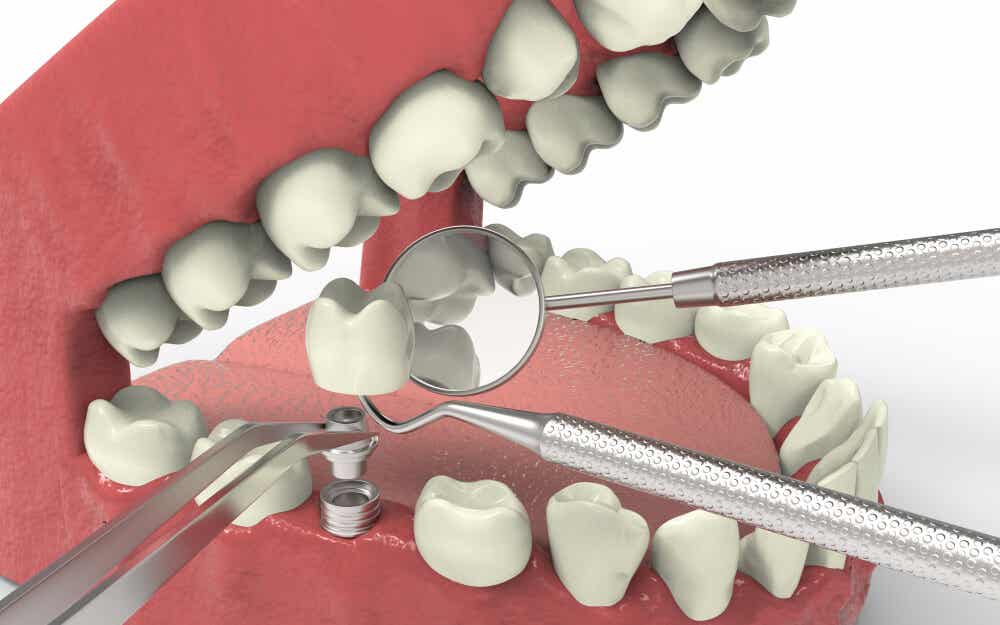 Recreación digital de un implante dental. Tratamiento para agenesia dental.