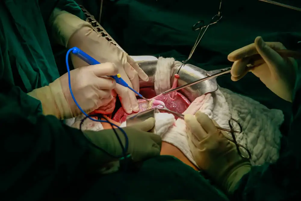 Trasplante de hígado.