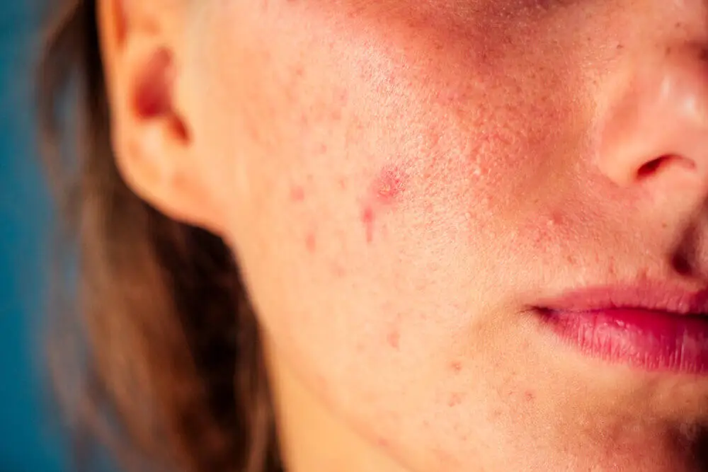 Rosto de mulher com acne que precisa de creme para cicatrizes.