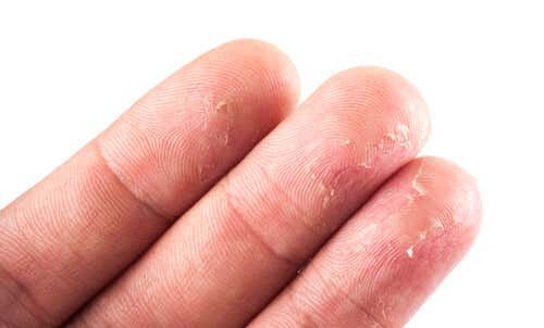 Tres dedos de una mano con eczema.