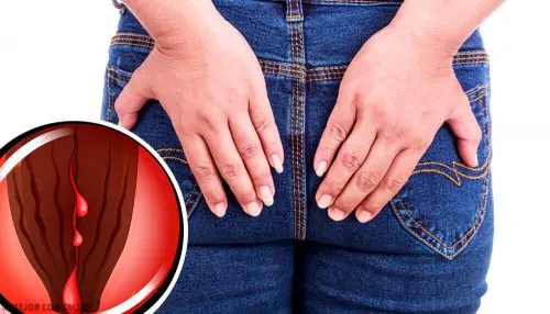 Las fisuras anales son desgarramientos de la mucosa de la parte final del intestino.