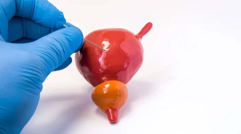 Aspiración suprapúbica de la vejiga