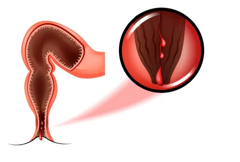 Tratamiento de la fisura anal