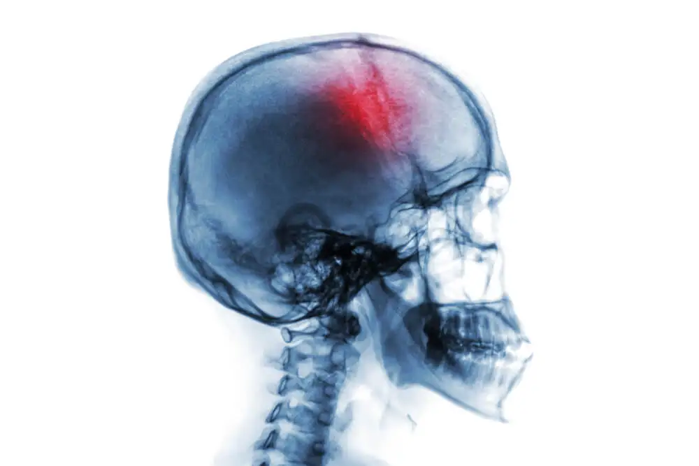 Derrame cerebral.