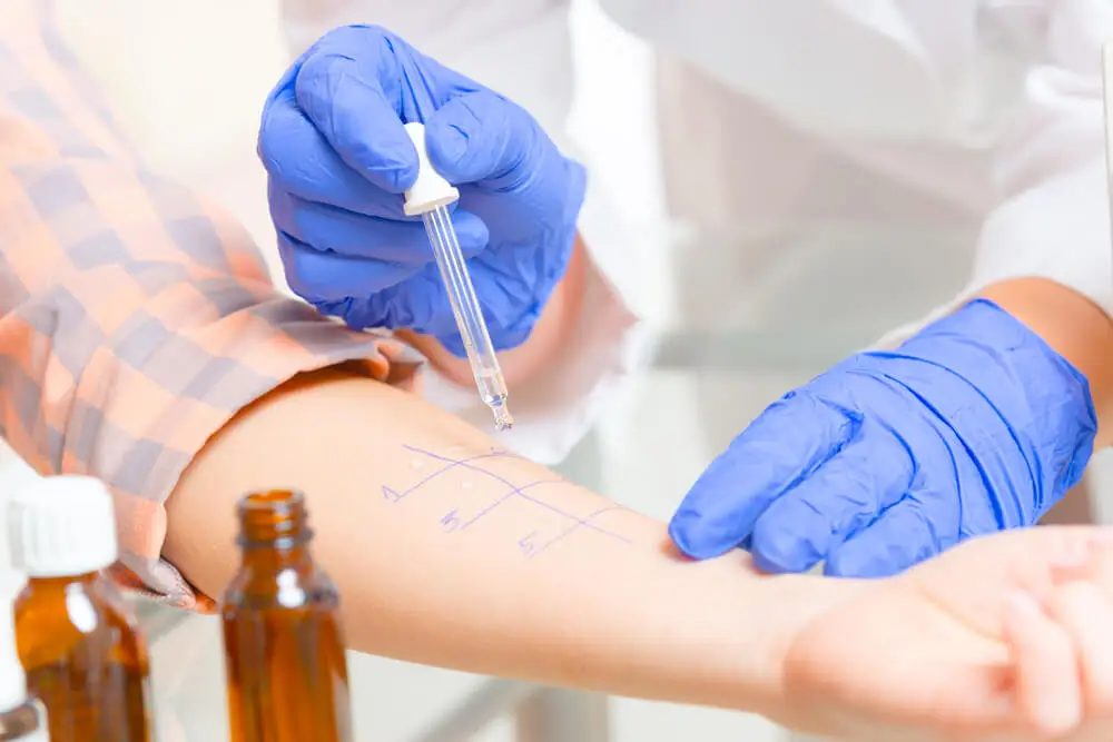 Médico realizando las pruebas de alergia a un paciente.