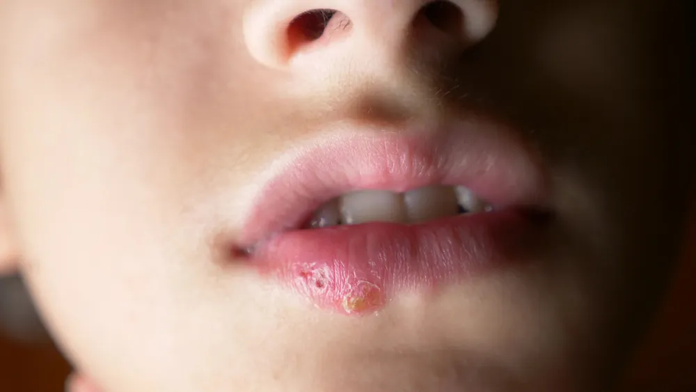 Herpes en niños.