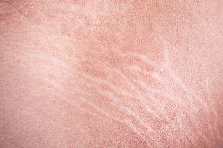 Tratamiento de aceite de ricino y aloe vera para aclarar las estrías