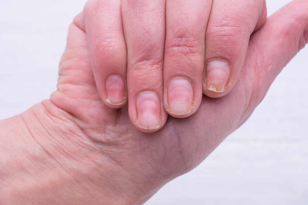 6 remedios para tratar las uñas amarillas y gruesas