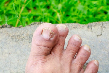 5 tipos de hongos en la piel y cómo identificarlos