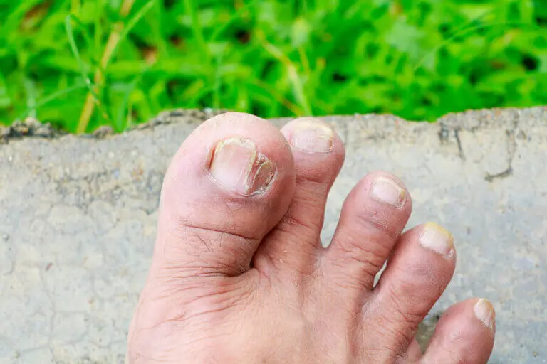 5 tipos de hongos en la piel y cómo identificarlos