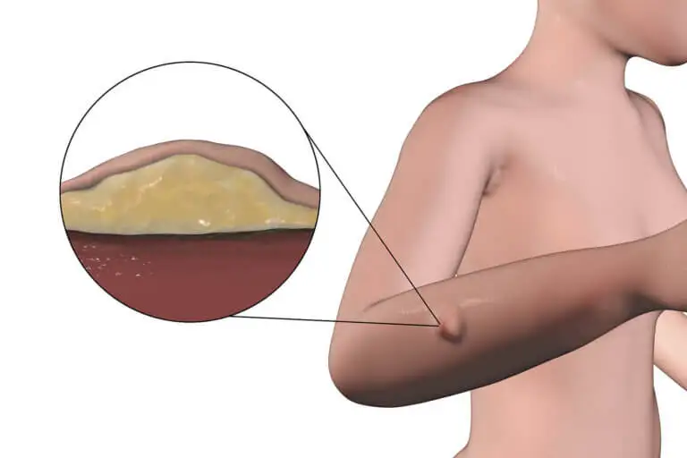 ¿Qué es un lipoma?
