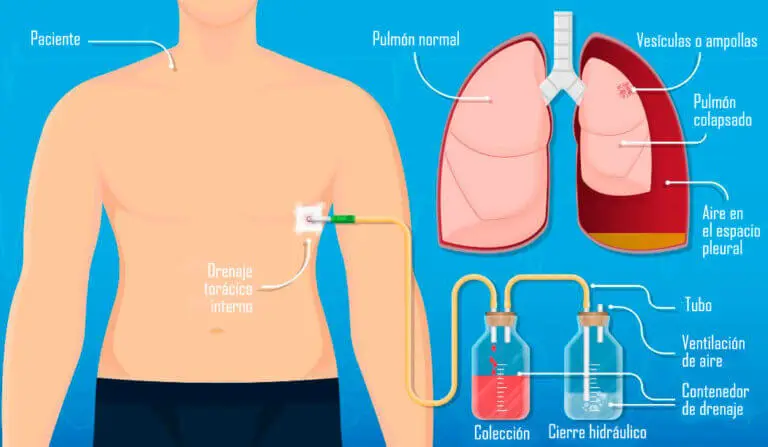 Toracostomía con aguja, técnica y cuidados posteriores