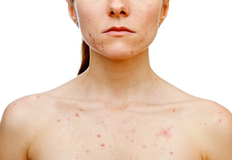 ¿Qué desencadena el acné en las mujeres?