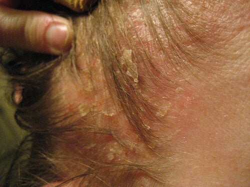 dermatitis en cuero cabelludo