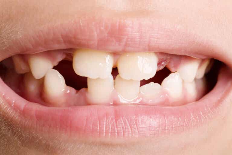 Agenesia dental: tipos y tratamientos