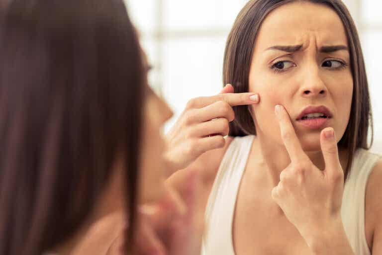 Granitos de acné: hábitos para disminuir su aparición