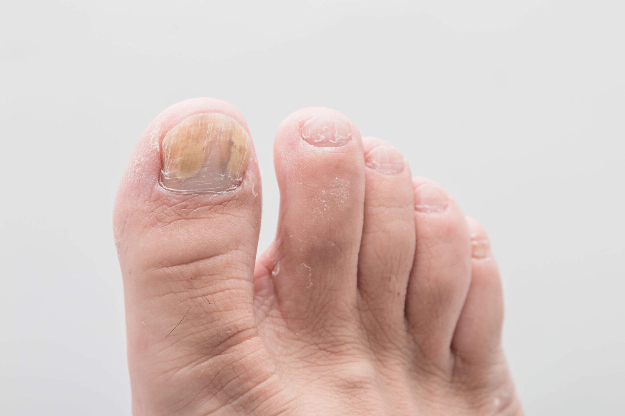 Remedios caseros para las uñas amarillas de los pies