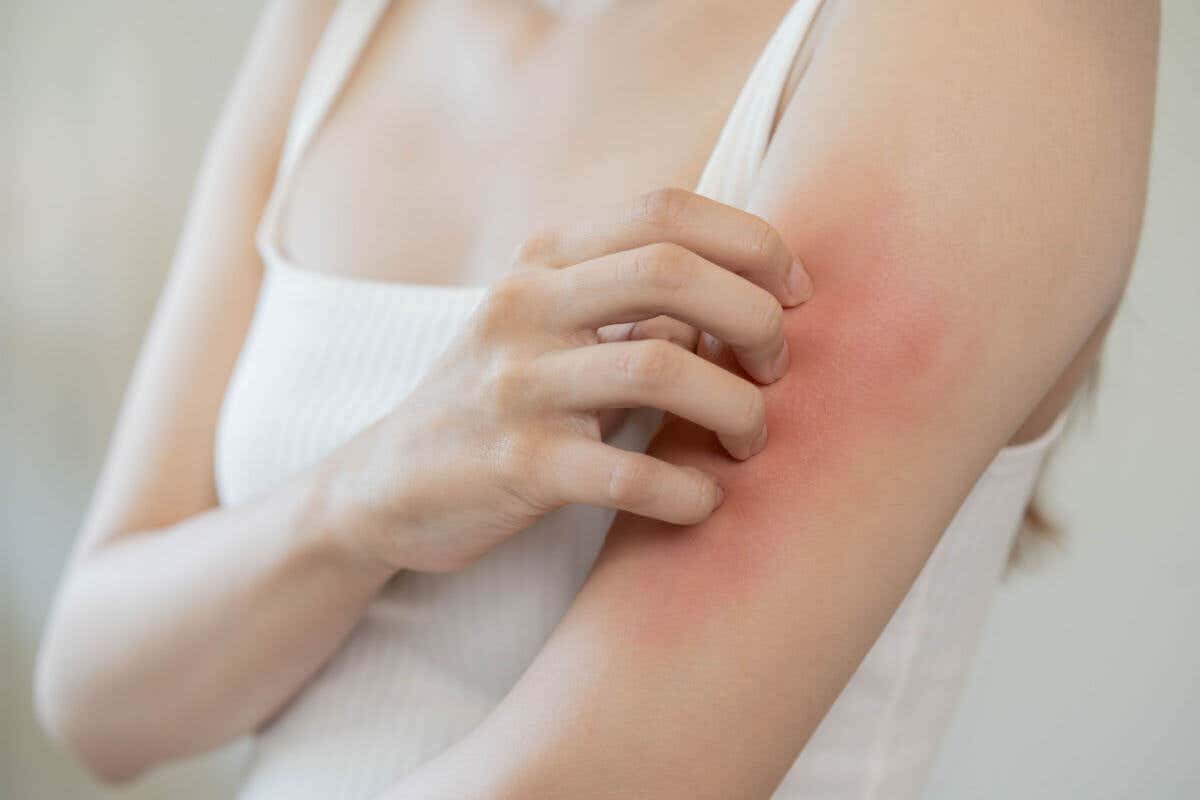 Mujer rascando su brazo por dermatositosis