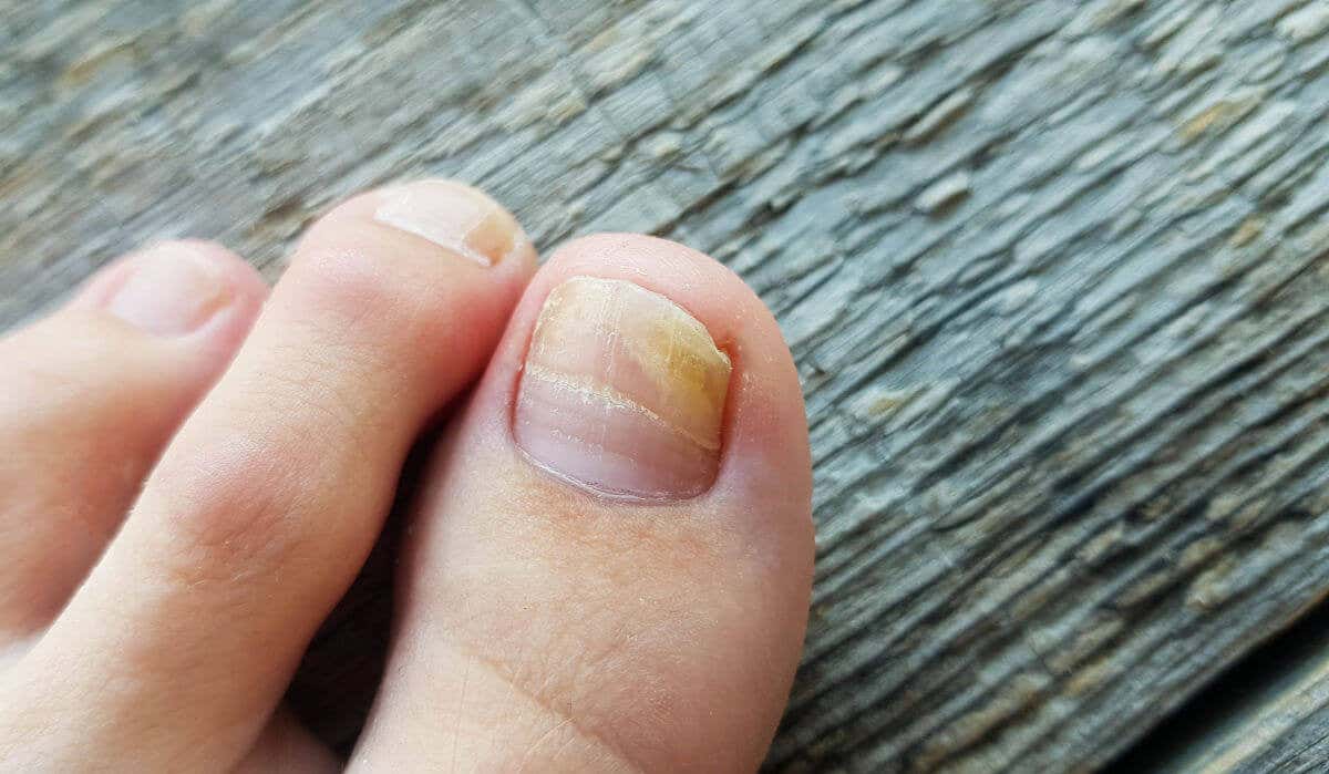 Persona con onicomicosis en el dedo del pie