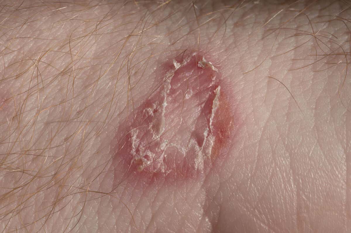 Tiña en la piel, una de las infecciones por hongo más comunes.