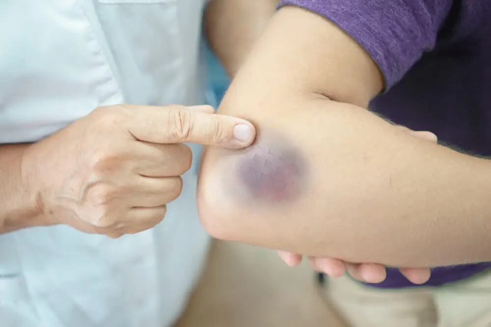 Hematoma por púrpura.