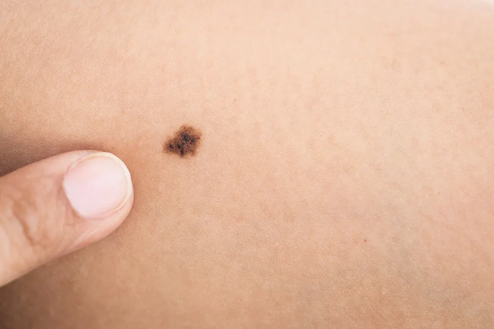 Melanoma es una enfermedad común de la piel.