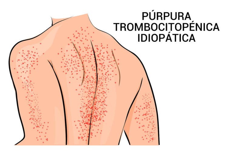 Púrpura: síntomas y cómo se debe tratar