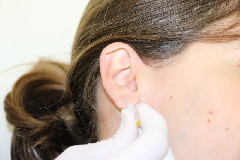 El tratamiento de auriculopuntura también se conoce como ''aguja permanente''.