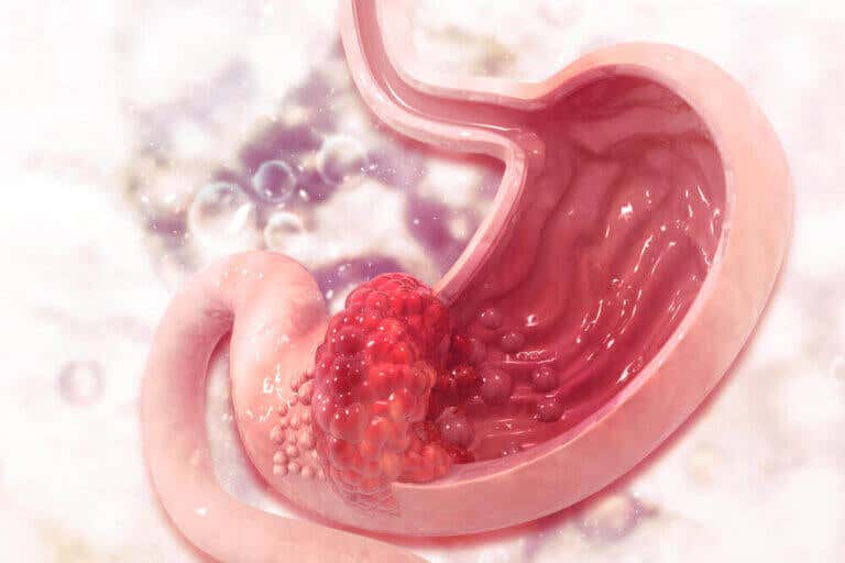 Úlcera gástrica: causas, síntomas y tratamiento