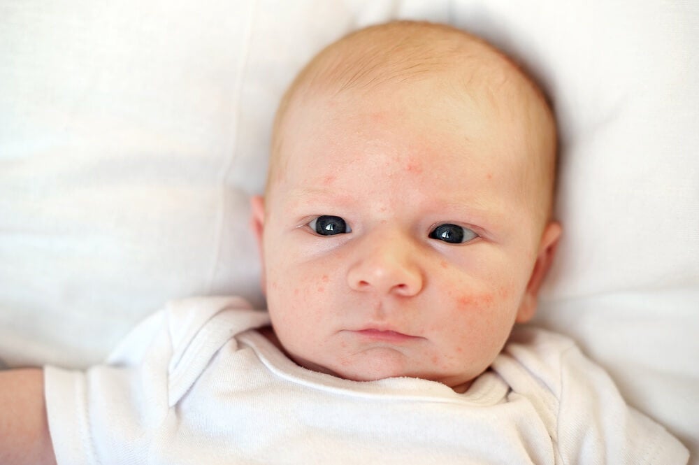 acné en el bebé