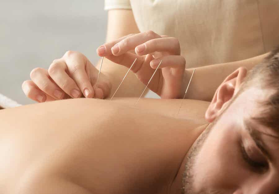 La acupuntura forma parte de las terapias naturales.
