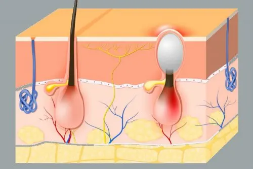 Fisiología del folículo piloso y el forúnculos vaginales