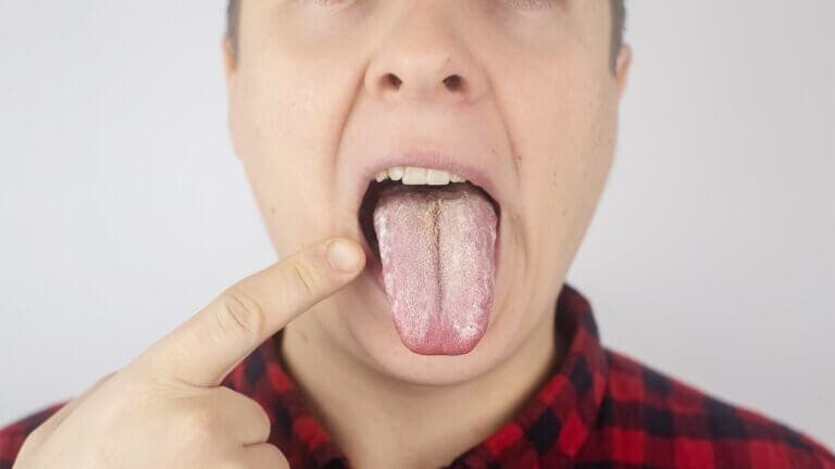 Remedios para la candidiasis oral: 10 alternativas naturales