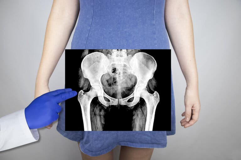Pubalgia: causas, síntomas y tratamiento