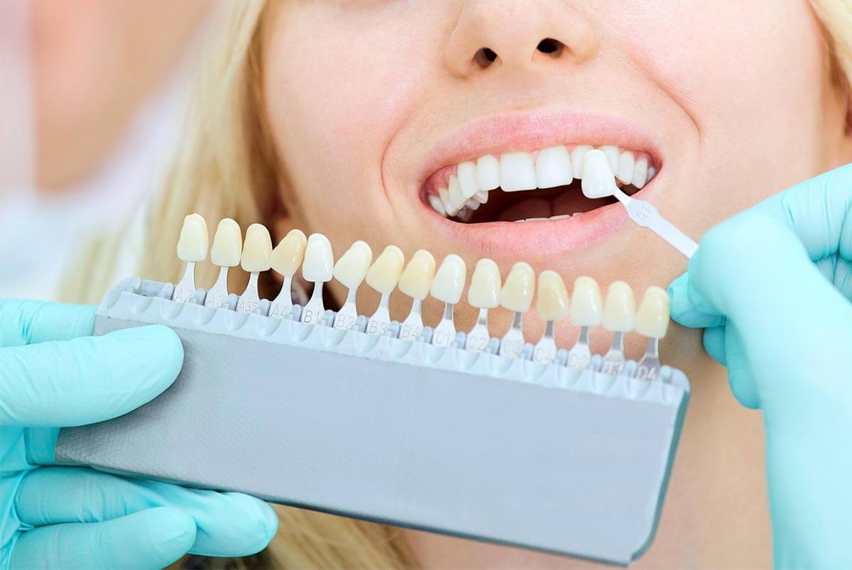 Blanqueamiento dental para quitar manchas.